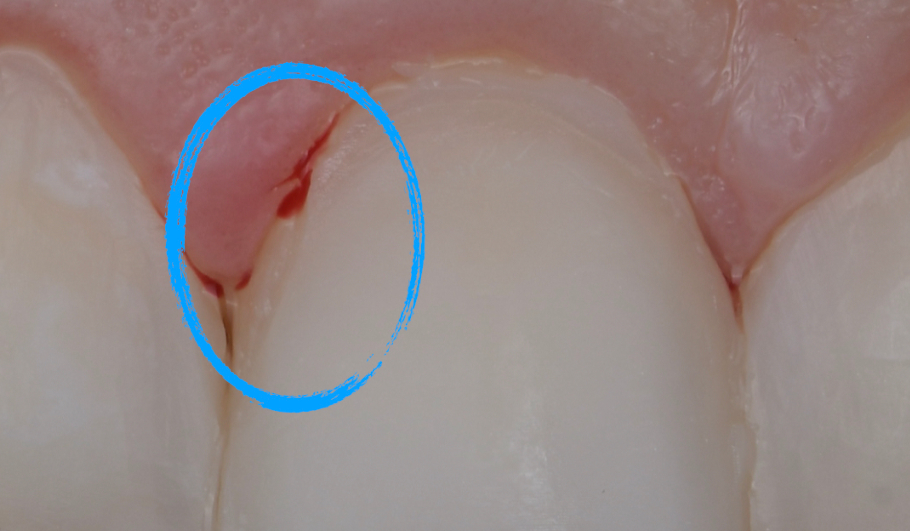 Figure 7a: Composite surface with a defect near the margin with blood contaminating the affected area.